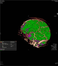 Perfusion nach Thrombektomie