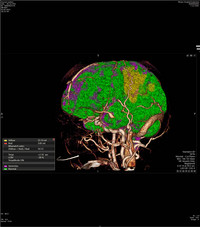 Perfusion vor Thrombektomie